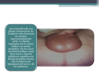 Ano imperforado con
fístula rectouretral. Es
el defecto más frecuente
en varones
(aproximadamente
50%). La fístula
comunica con la uretra
bulbar o la uretra
prostática. En los casos
con fístula bulbar existe
buen sacro y buenos
esfínteres; aquellos con
fístula prostática tienen
alta incidencia de
hipoplasia del sacro y de
los esfínteres.
 