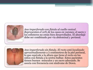 Ano imperforado con fístula al cuello vesical.
Representan el 10% de los casos en varones; el sacro y
los esfínteres no están bien desarrollados. El abordaje
debe ser combinado por vía abdominal y perineal.
Ano imperforado sin fístula. El recto está localizado
aproximadamente a 2 centímetros de la piel perineal,
lo que equivale a la altura que tiene el recto en los
niños con fístula a la uretra bulbar. Estos pacientes
tienen buenos músculos y un sacro adecuado. Se
asocia con frecuencia con síndrome de Down.
 