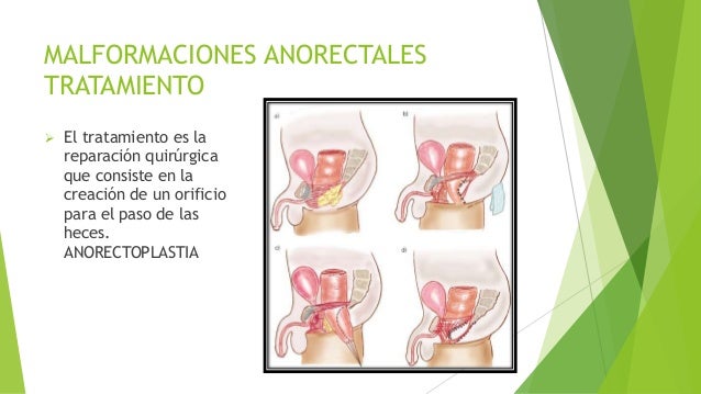 Malformaciones anorrectales Malformaciones anorrectales