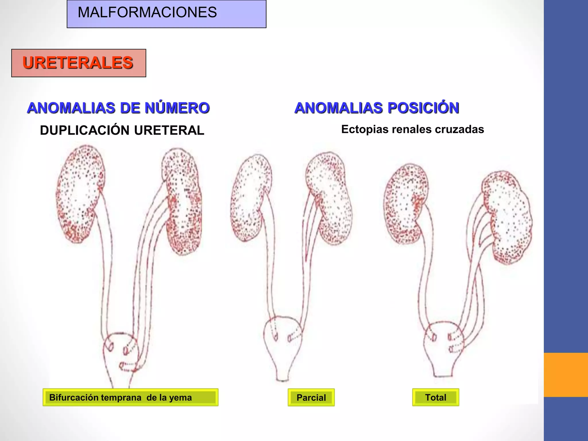 Malformaciones del Aparato Urinario. Dr. Igor Pardo Zapata 2017 | PPTX