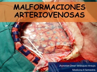 MALFORMACIONES
ARTERIOVENOSAS
Jhonatan Omar Velásquez Araujo.
Medicina X Semestre.
 