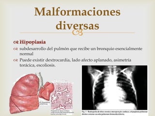 Malformaciones
             diversas
                
 subdesarrollo del pulmón que recibe un bronquio esencialmente
  normal
 Puede existir dextrocardia, lado afecto aplanado, asimetría
  torácica, escoliosis.
 