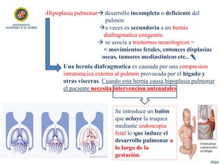 -Hipoplasia pulmonar desarrollo incompleto o deficiente del
pulmon
a veces es secundaria a un hernia
diafragmatica conge...