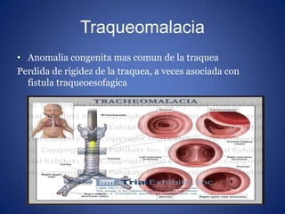 Traqueomalacia
• Anomalia congenita mas comun de la traquea
Perdida de rigidez de la traquea, a veces asociada con
fistula...