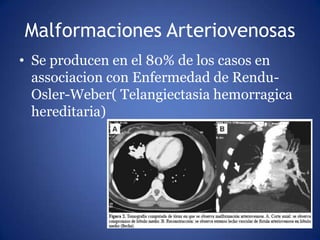 Malformaciones Arteriovenosas
• Se producen en el 80% de los casos en
associacion con Enfermedad de Rendu-
Osler-Weber( Te...