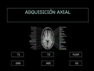 ADQUISICIÓN AXIAL
T1 T2 FLAIR
DWI ADC EG
 