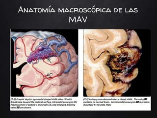 Anatomía macroscópica de las
MAV
 