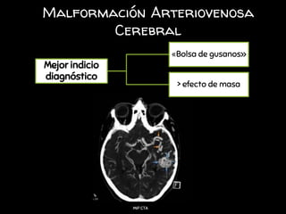 Malformación Arteriovenosa
Cerebral
Mejor indicio
diagnóstico
«Bolsa de gusanos»
> efecto de masa
MIP CTA
 