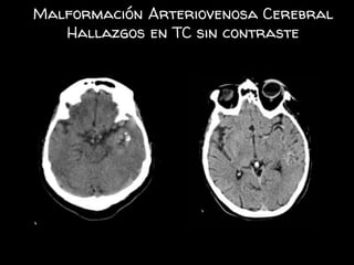 Malformación Arteriovenosa Cerebral
Hallazgos en TC sin contraste
 