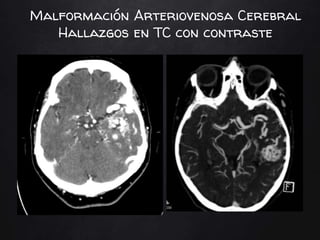 Malformación Arteriovenosa Cerebral
Hallazgos en TC con contraste
 