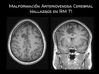 Malformación Arteriovenosa Cerebral
Hallazgos en RM T1
 