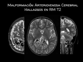 Malformación Arteriovenosa Cerebral
Hallazgos en RM T2
 