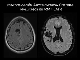 Malformación Arteriovenosa Cerebral
Hallazgos en RM FLAIR
 