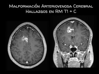 Malformación Arteriovenosa Cerebral
Hallazgos en RM T1 + C
 