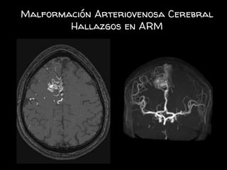 Malformación Arteriovenosa Cerebral
Hallazgos en ARM
 