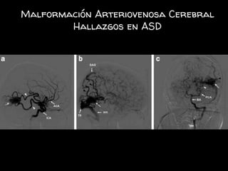 Malformación Arteriovenosa Cerebral
Hallazgos en ASD
 