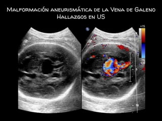 Malformación aneurismática de la Vena de Galeno
Hallazgos en US
 