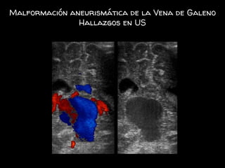Malformación aneurismática de la Vena de Galeno
Hallazgos en US
 