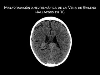 Malformación aneurismática de la Vena de Galeno
Hallazgos en TC
 