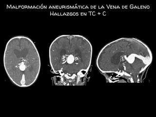 Malformación aneurismática de la Vena de Galeno
Hallazgos en TC + C
 