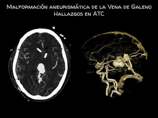 Malformación aneurismática de la Vena de Galeno
Hallazgos en ATC
 