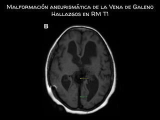Malformación aneurismática de la Vena de Galeno
Hallazgos en RM T1
 