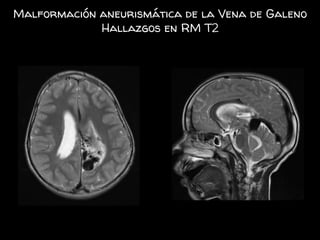Malformación aneurismática de la Vena de Galeno
Hallazgos en RM T2
 