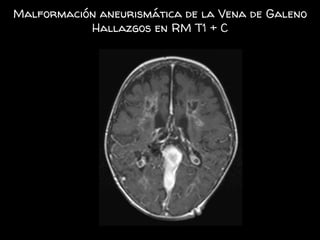 Malformación aneurismática de la Vena de Galeno
Hallazgos en RM T1 + C
 