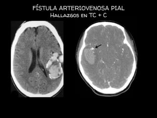 FÍSTULA ARTERIOVENOSA PIAL
Hallazgos en TC + C
 