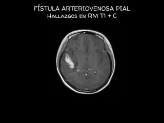 FÍSTULA ARTERIOVENOSA PIAL
Hallazgos en RM T1 + C
 