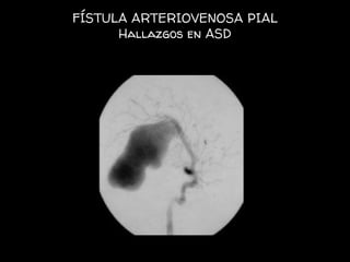 FÍSTULA ARTERIOVENOSA PIAL
Hallazgos en ASD
 