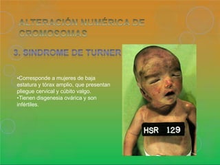 •Corresponde a mujeres de baja
estatura y tórax amplio, que presentan
pliegue cervical y cúbito valgo.
•Tienen disgenesia ovárica y son
infértiles.
 