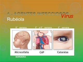 Rubéola
Virus
6° semana
SORDERA
9° semana 5° a 8° semana
 