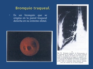  Es un bronquio que se
origina en la pared traqueal
derecha en su extremo distal.
 