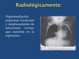 Hiperinsuflación
pulmonar localizada
y desplazamiento de
estructuras vecinas
que aumenta en la
espiración.
 