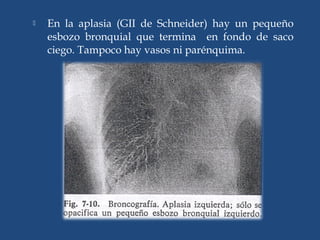  En la aplasia (GII de Schneider) hay un pequeño
esbozo bronquial que termina en fondo de saco
ciego. Tampoco hay vasos ni parénquima.
 