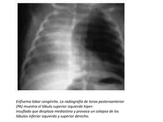 Tx:
• Qx, lobectomía en casos graves con distrés
  respiratorio, en asintomaticos o con afeccion
  minima, solo observacio...