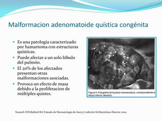 Tumores y quistes mediastinales
 (Neuroblastoma mediastinico)

                                                           ...