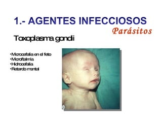 Toxoplasma gondii  Microcefalia en el feto Microftalmia Hidrocefalia Retardo mental   Parásitos 