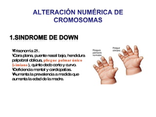 Trisonomía 21. Cara plana, puente nasal bajo, hendidura palpebral oblicua,  pliegue palmar único (simiano ), quinto dedo corto y curvo. Deficiencia mental y cardiopatías. Aumenta la prevalencia a medida que aumenta la edad de la madre. 