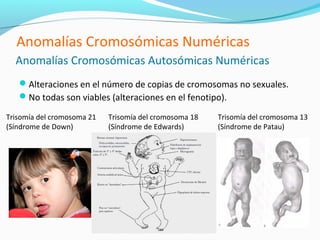 Anomalías Cromosómicas Numéricas
  Anomalías Cromosómicas Autosómicas Numéricas
   Alteraciones en el número de copias de cromosomas no sexuales.
   No todas son viables (alteraciones en el fenotipo).

Trisomía del cromosoma 21   Trisomía del cromosoma 18   Trisomía del cromosoma 13
(Síndrome de Down)          (Síndrome de Edwards)       (Síndrome de Patau)
 
