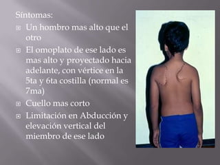 Síntomas:
 Un hombro mas alto que el
   otro
 El omoplato de ese lado es
   mas alto y proyectado hacia
   adelante, con vértice en la
   5ta y 6ta costilla (normal es
   7ma)
 Cuello mas corto

 Limitación en Abducción y
   elevación vertical del
   miembro de ese lado
 