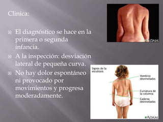 Clinica:

   El diagnóstico se hace en la
    primera o segunda
    infancia.
   A la inspección: desviación
    lateral de pequeña curva.
   No hay dolor espontáneo
    ni provocado por
    movimientos y progresa
    moderadamente.
 