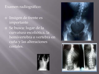 Examen radiográfico:

   Imágen de frente es
    importante
   Se busca: lugar de la
    curvatura escoliótica, la
    hemivertebra o vertebra en
    cuña y las alteraciones
    costales.
 