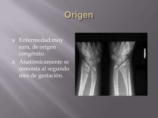    Enfermedad muy
    rara, de origen
    congénito.
   Anatómicamente se
    remonta al segundo
    mes de gestación.
 