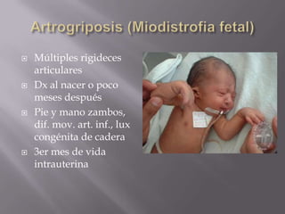    Múltiples rigideces
    articulares
   Dx al nacer o poco
    meses después
   Pie y mano zambos,
    dif. mov. art. inf., lux
    congénita de cadera
   3er mes de vida
    intrauterina
 