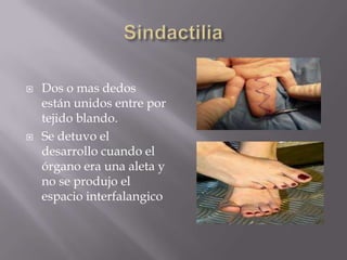    Dos o mas dedos
    están unidos entre por
    tejido blando.
   Se detuvo el
    desarrollo cuando el
    órgano era una aleta y
    no se produjo el
    espacio interfalangico
 