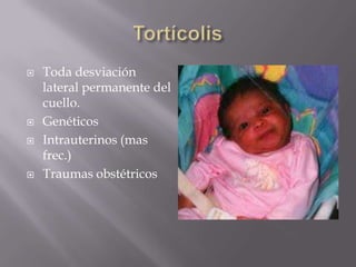    Toda desviación
    lateral permanente del
    cuello.
   Genéticos
   Intrauterinos (mas
    frec.)
   Traumas obstétricos
 