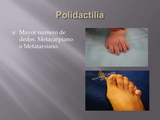    Mayor numero de
    dedos. Metacarpiano
    o Metatarsiano.
 