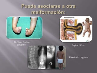 Pie Varo Equino
   congénito        Espina bífida




                  Escoliosis congénita
 